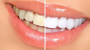Teeth whitening FAQs