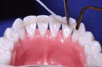 Tooth replacement without grinding